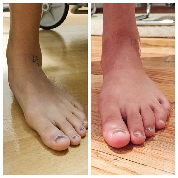 Before and After of Flat Foot Patient