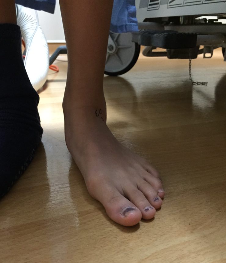 Before photo of flat foot patient