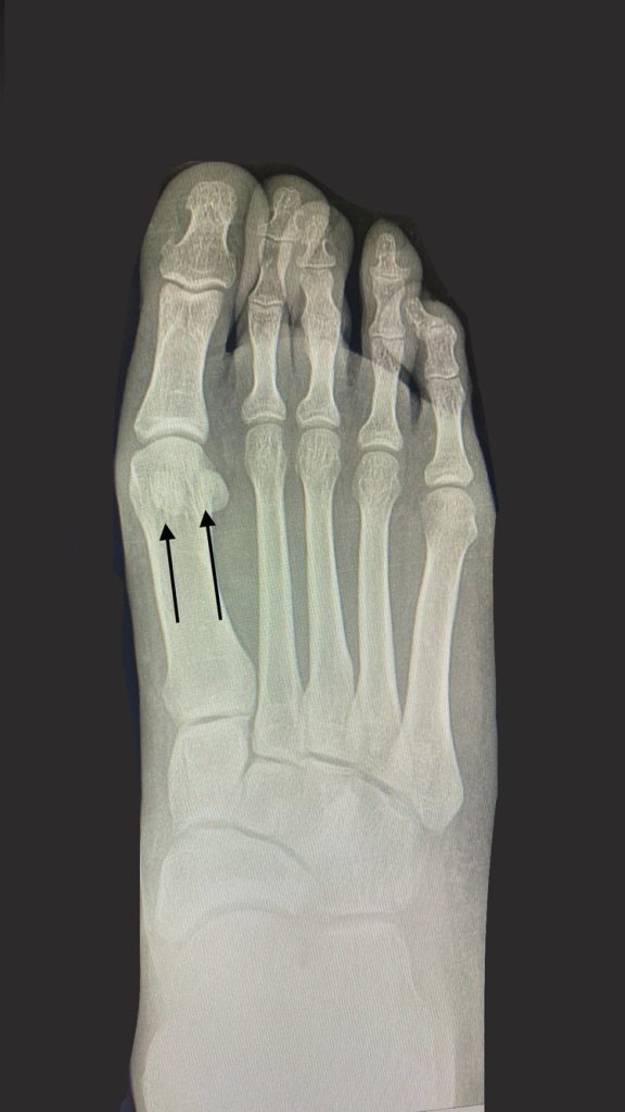 x ray of foot