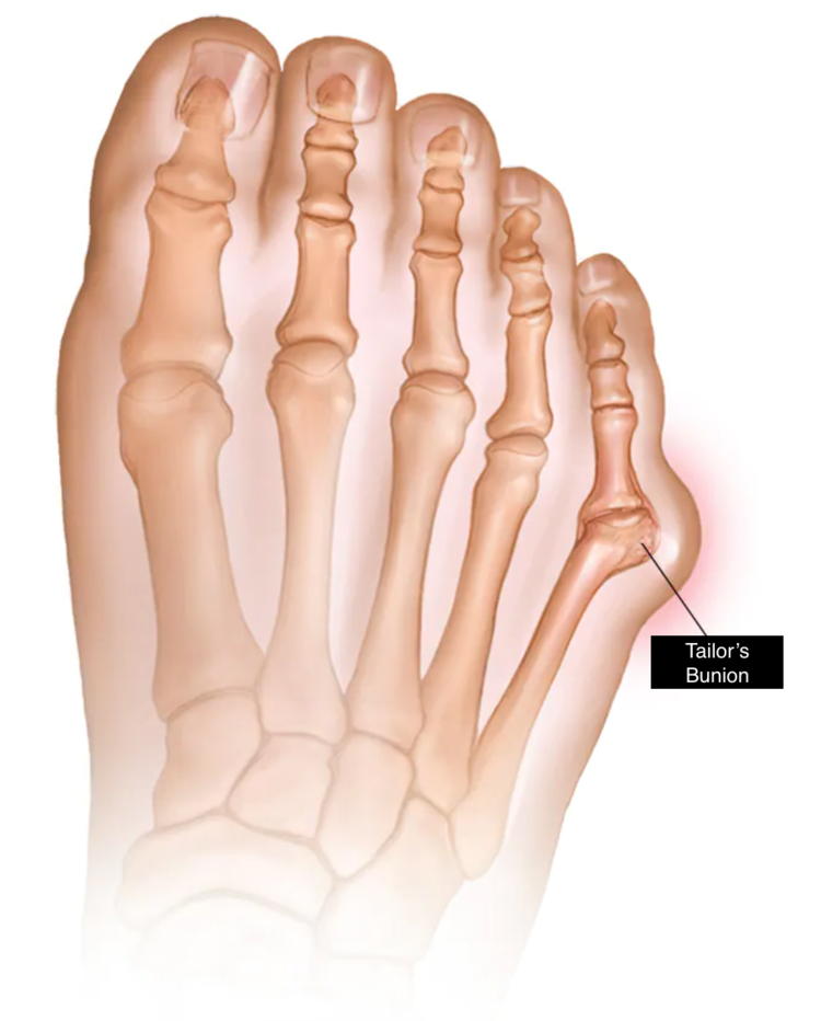 animated diagram showing a tailor's bunion in a foot