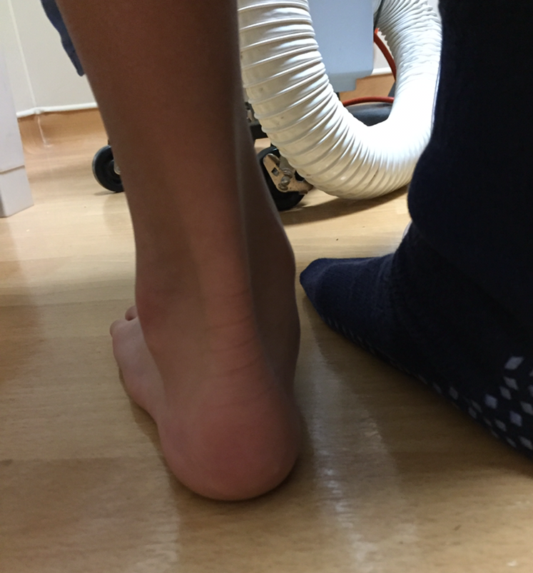 Back view of flat foot patient after surgery