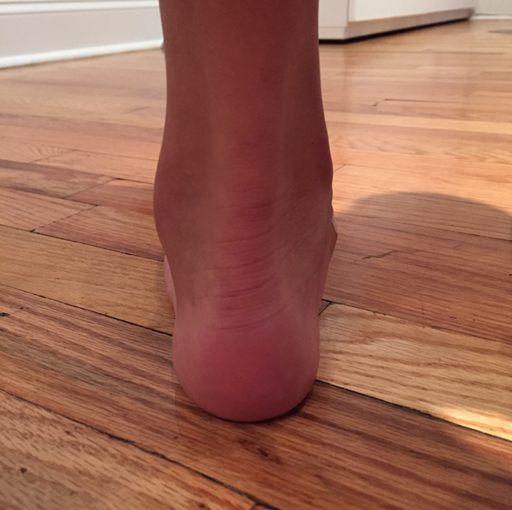 Back view of flat foot patient before surgery