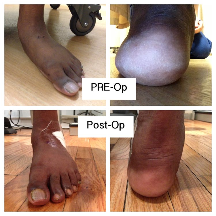 before-after-photos-flat-foot-patient