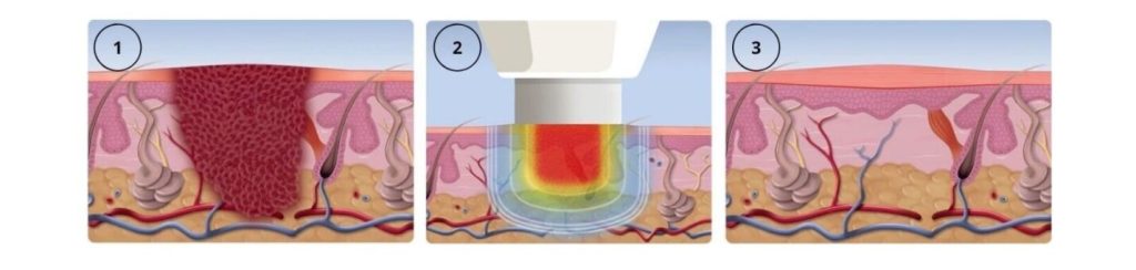 Swift Therapy for Plantar Warts