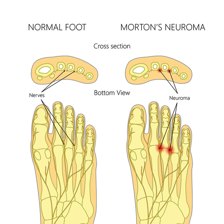 Neuroma pain illustration